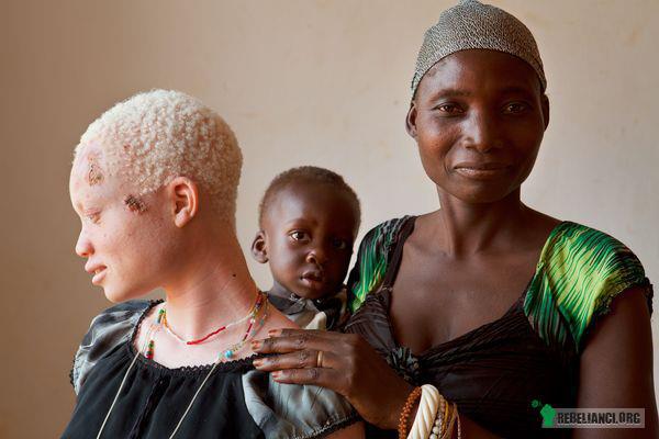 Albinoska z Tanzanii. – &quot;Prześladowania osób dotkniętych albinizmem bazują na przekonaniu, jakoby niektóre części ciała albinosów posiadały magiczną moc[1]. Ten przesąd, występujący głównie we wschodniej Afryce, jest rozpowszechniany przez uzdrowicieli i szamanów, którzy używają części ciała albinosów jako składników stosowanych do różnych rytuałów mikstur i eliksirów, twierdząc, że przy użyciu magicznych mocy przyniosą one powodzenie ich nabywcom[2]. Powoduje to, że ludzie dotknięci albinizmem są prześladowani, okaleczani i mordowani, a ich groby profanowane. Jednocześnie albinosi spotykają się z ostracyzmem, a nawet przemocą z morderstwami włącznie, z powodu przekonania jakoby byli oni przeklęci i przynosili nieszczęście&quot; 